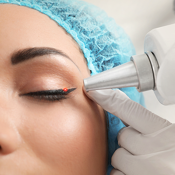  Laserowe usuwanie kresek na powiekach 